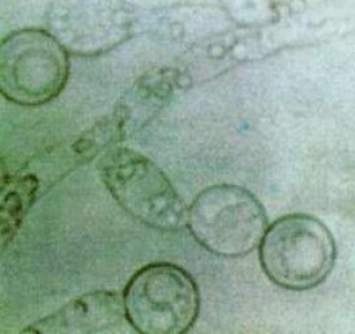 monilia albicans.jpg